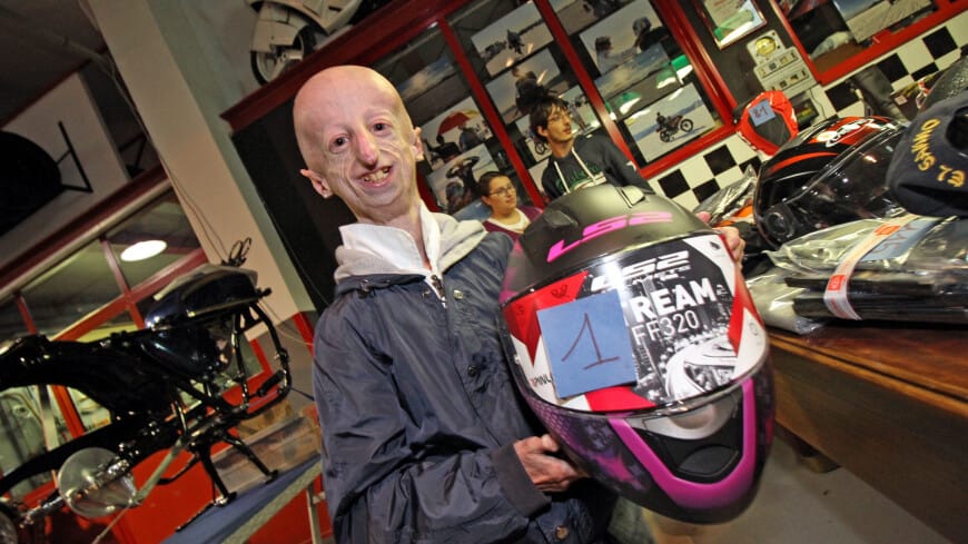Sammy Basso, Longest-Living Progeria Patient, Dies