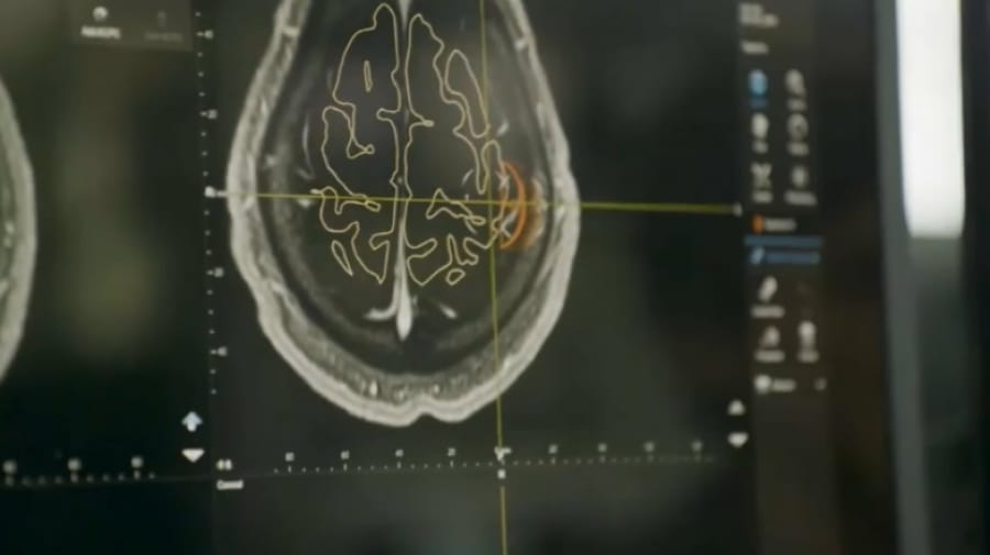 «Neuralink» ikinji meýletinçiniň beýnisine çip oturtmakçy